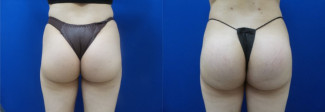 al-buttock-augmentation-before-after-photo