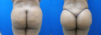 bc-buttock-augmentation-before-after-photo