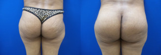 cf-buttock-augmentation-before-after-photo