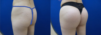 ed-buttock-augmentation-before-after-photo