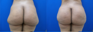 gq-buttock-augmentation-before-after-photo