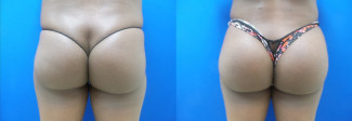 jm-buttock-augmentation-before-after-photo