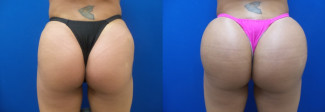 js-buttock-augmentation-before-after-photo