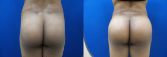 kh-buttock-augmentation-before-after-photo