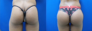 kw-buttock-augmentation-before-after-photo