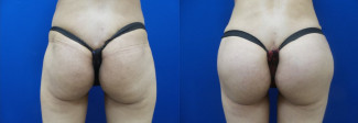 lac-buttock-augmentation-before-after-photo