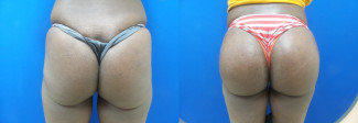 phc-buttock-augmentation-before-after-photo