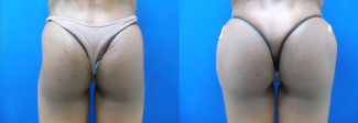 pw-buttock-augmentation-before-after-photo