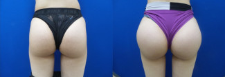 sj-buttock-augmentation-before-after-photo