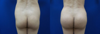 sl-buttock-augmentation-before-after-photo