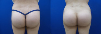 tr-buttock-augmentation-before-after-photo