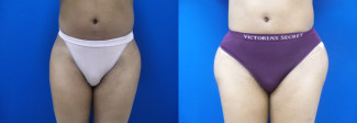 ch-hip-implants-before-after-photo