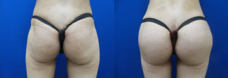 lac-hip-implants-before-after-photo