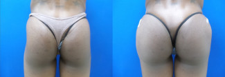 pw-hip-implants-before-after-photo