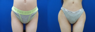 sj-hip-implants-before-after-photo