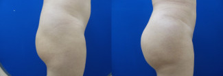 sl-hip-implants-before-after-photo