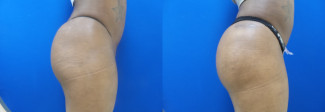 sm-hip-implants-before-after-photo