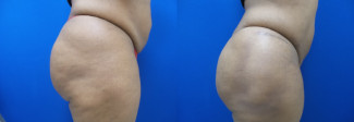 tg-hip-implants-before-after-photo