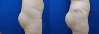 tr-hip-implants-before-after-photo