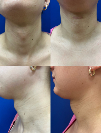 tracheal-shave-plastic-surgery-nyc